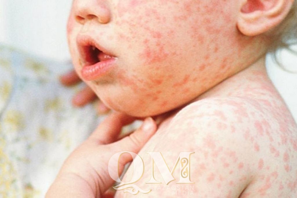 12 случаев заболевания корью зарегистрировали в СКО