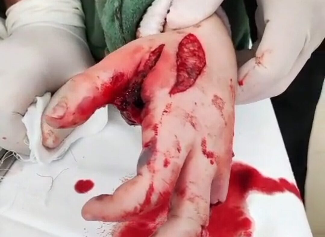 Видео с оторванными пальцами ребенка распространяют в мессенджерах Петропавловска