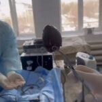 Петропавлда әйелдің өтінен тауық жұмыртқасындай тас алынды