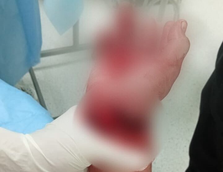 Кисть висела: врачи из Петропавловска спасли руку подростку