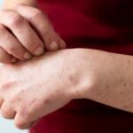 Жыл басынан 19 солтүстікқазақстандық описторхозбен ауырған