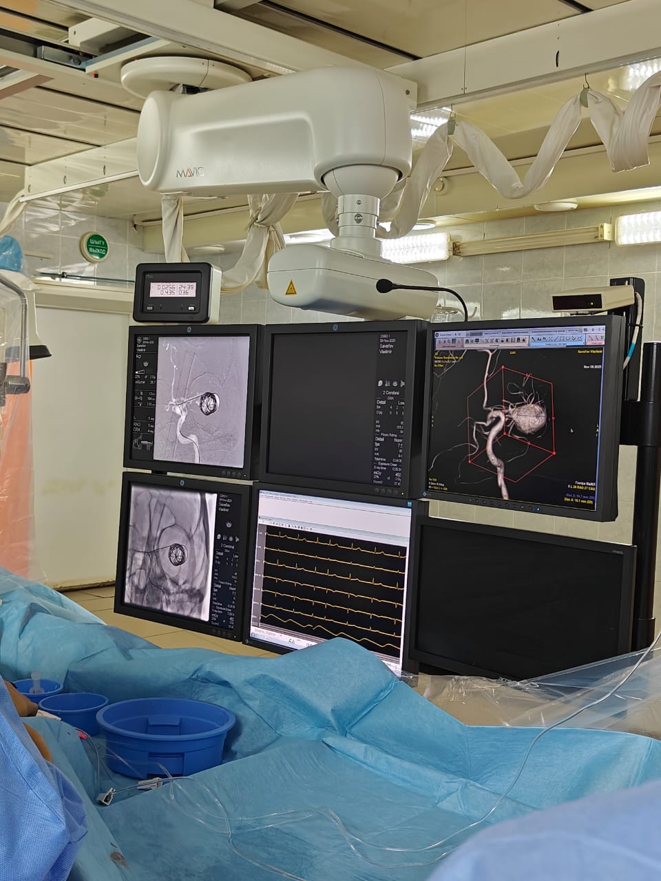 Солтүстік Қазақстанда МӘМС-тің арқасында алғаш рет ми ісігіне эмболизация отасы жасалды