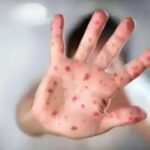 СҚО-да жыл басынан 65 адам қызылшамен ауырған