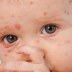 СҚО-да былтыр 70 адам қызылшамен ауырған