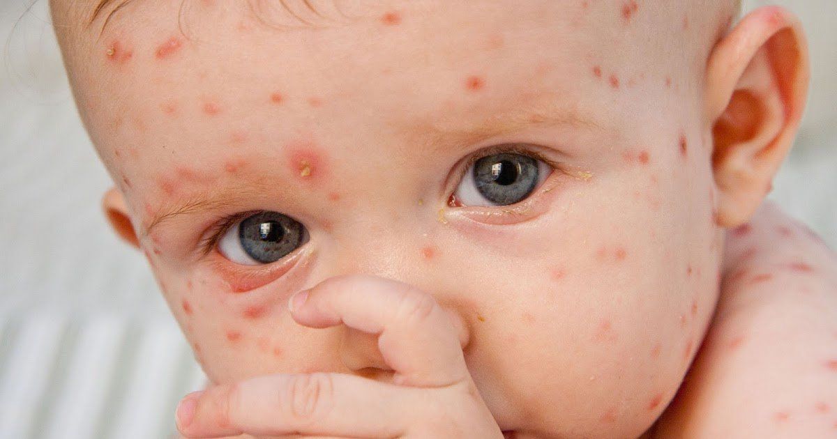 СҚО-да былтыр 70 адам қызылшамен ауырған