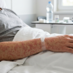 90 % заболевших корью в СКО не имели прививок