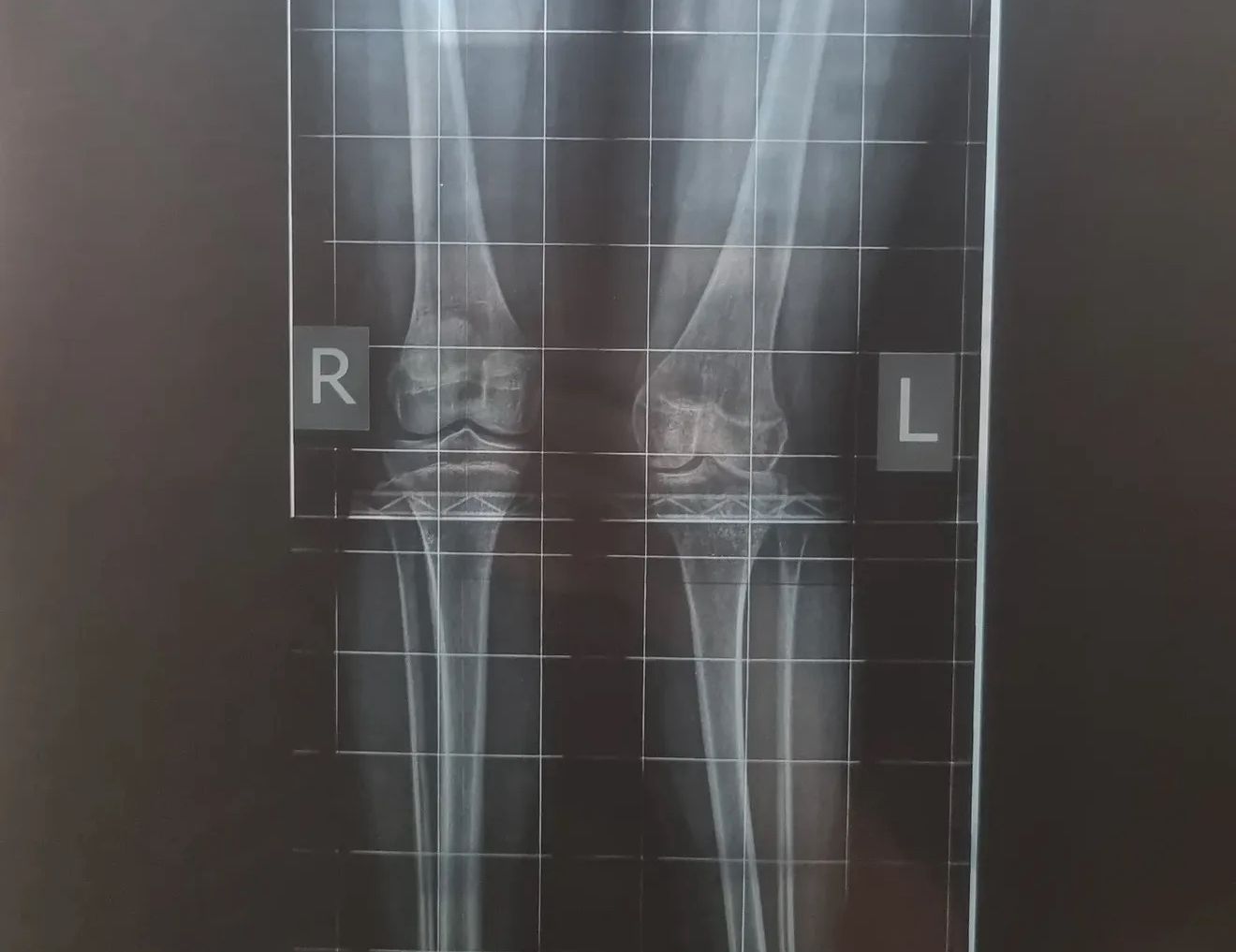 Деньги на лечение 13-летней дочери собирает многодетная семья Култышевых из Петропавловска