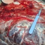 10-килограммовую опухоль удалили женщине онкологи СКО
